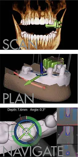 x guide dental implant examples